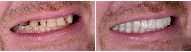 Before and after dental case 1