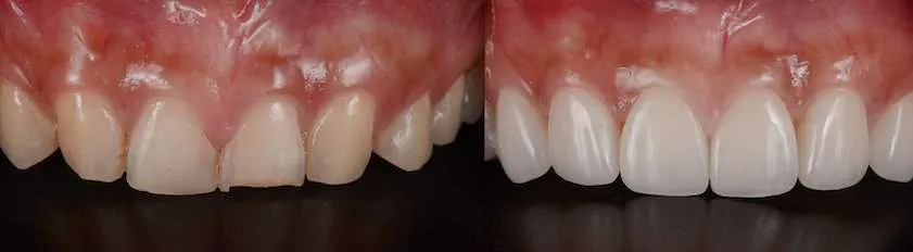 Before and after dental case 3