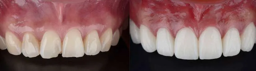 Before and after dental case 4